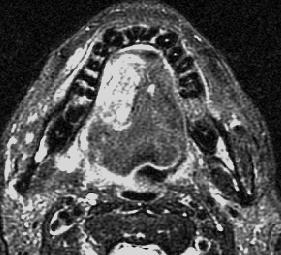 188 C K Ong and V F H Chong Figure 2 Axial T2 weighted fat-suppression image shows a right-sided tongue cancer extending more than 5 mm from the lateral margin of the tongue.