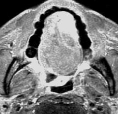 Genioglossus is the largest of all the tongue muscles and forms the bulk of the tongue. It arises from the genial tubercle and is easily seen on computed tomography (CT) and MRI (Fig. 1).