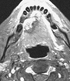 Imaging of tongue carcinoma 189 (c) Figure 4 Axial post-contrast T1 weighted fat-suppression image shows a right-sided oral tongue carcinoma (arrow).
