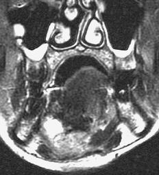 (c) Coronal T2 weighted fat-suppression image of another patient shows a right-sided oral tongue cancer (short arrow).