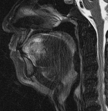 Imaging of tongue carcinoma 191 Figure 7 Sagittal T2 weighted fat-suppression image shows carcinoma