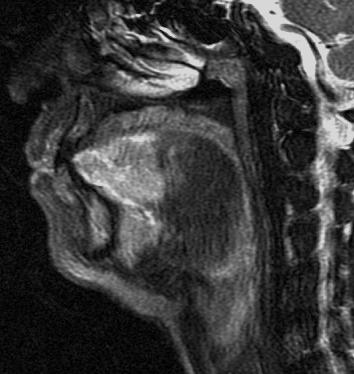 Sagittal T2 weighted fat-suppression image (same patient) shows tumour invading the floor of the