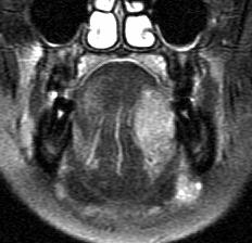 Figure 8 Coronal T2 weighted fat-suppression image shows a carcinoma in the middle third of the
