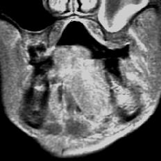 Note the ipsilateral submandibular lymphadenopathy (short arrow).