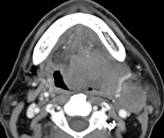 invading the lateral floor of the  Figure 9 Axial post-contrast CT image shows a large left-side