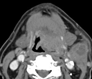 Note the extension across the midline (long arrow) and the ipsilateral enlarged jugulodigastric