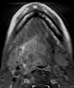 192 C K Ong and V F H Chong Figure 10 Axial post-contrast T1 weighted fat-suppression image shows a large tongue base tumour (opposing arrows).