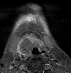 Figure 11 Axial post-contrast CT image shows an exophytic a left-sided vallecular cancer (arrows).