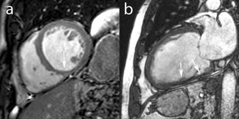 MRI: Viability 58 yrs old man (EF-20%) Dilated cardiomyopathy Thinning of inferior wall on still images