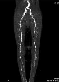 Calcification in CFA Disease Calcification is a key underlying factor in CFA disease Common Femoral Endarterectomy (CFE) is the standard of care for common femoral artery stenosis CFE is associated