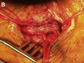 Common Femoral Endarterectomy (CFE): Patient Selection and Considerations Not all patients are