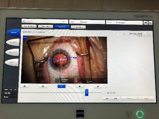 IMPLANT) WITH TRIFOCAL TECHNOLOGY 4,1 9,8 IOL MASTER 700 86,2 2 Eye In 1 Eye Out Both Eyes Out 96% OF
