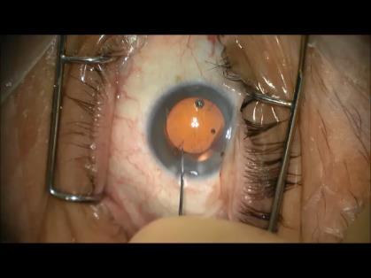 MTF Quality of Vision Drops Down From 100% to 0% with Only 8 Degree Axis Rotation Misalignment with a Toric IOLs Implant to Correct 2 D Astigmatism MTF (50 lp/mm)