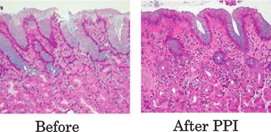 Chapter 13 Stomach and Proximal Duodenum: Inflammatory and Miscellaneous Disorders 597 Figure 13-23. Oxyntic mucosa before and after a 2-week course of PPIs in a Helicobacter-positive patient.