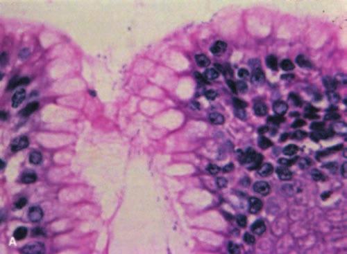 598 Lewin, Weinstein, and Riddell s Gastrointestinal Pathology and Its Clinical Implications Figure 13-24. A: Detail (high dry) view of H. pylori organisms at the entrance of a gastric pit.