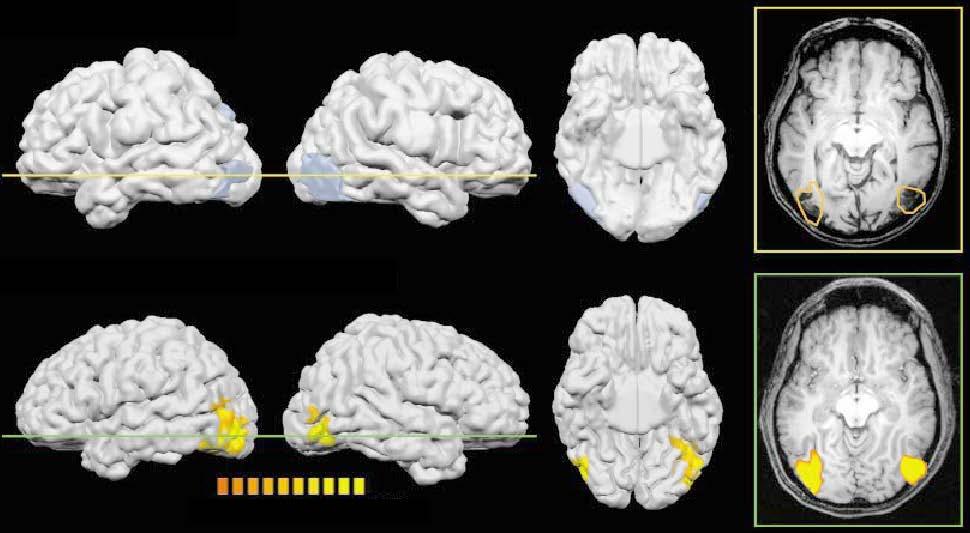 Ventral occipital lesions impair object recognition but not object-directed grasping: an fmri study. James et al.