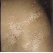 Vitiligo patches on the right side of the trunk () prior to NUV phototherapy,