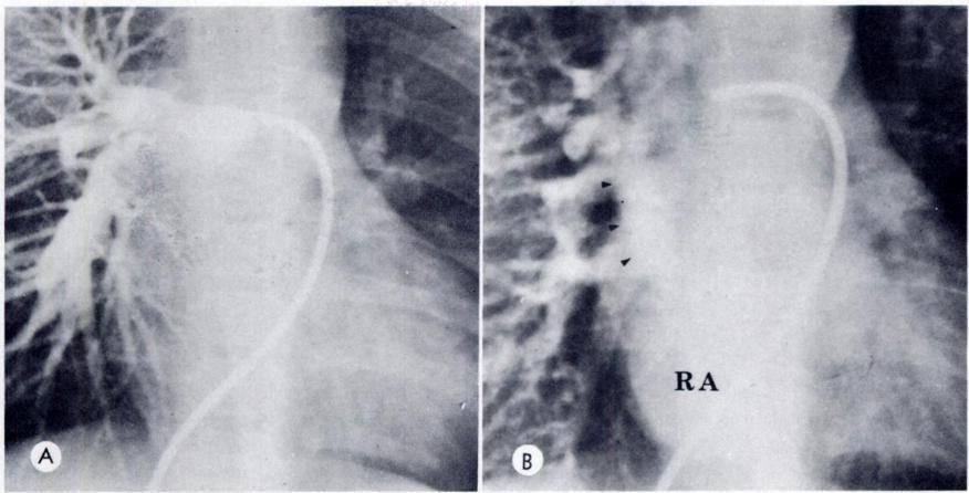 VOL. 121, No. 3 Partial Anomalous Pulmonary Venous Connection 595 #{149}1 -:. I FiG. 3. Patient with right partial anomalous pulmonary venous connection and an associated small sinus venosus ASD.