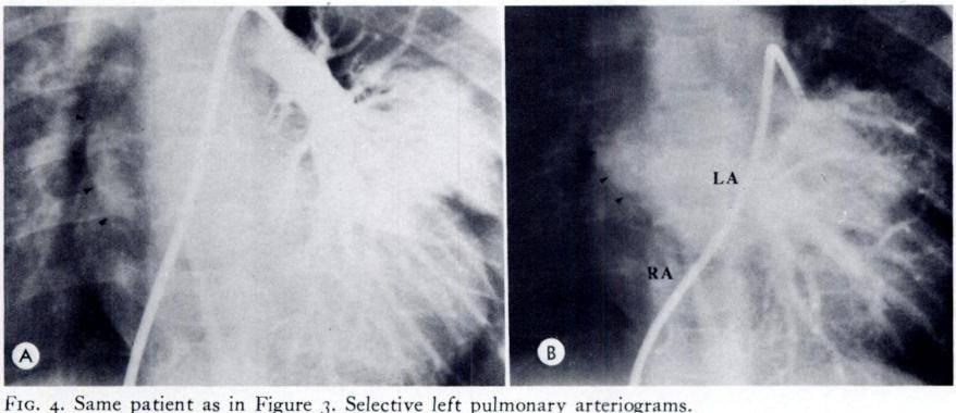 (B) The venous ( levo ) phase demonstrates the anomalous right pulmonary veins connecting to and opacifying first the dilated ampulla of the superior vena cava (black arrowheads) and then the right