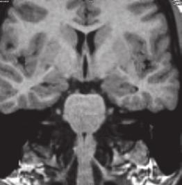 244 Underlying Mechanisms of Epilepsy A Fig. 3. A-T1W MPRAGE 1mm thick image perpendicular to the long axis of hippocampus. B- Outline of hippocampus in cross section.