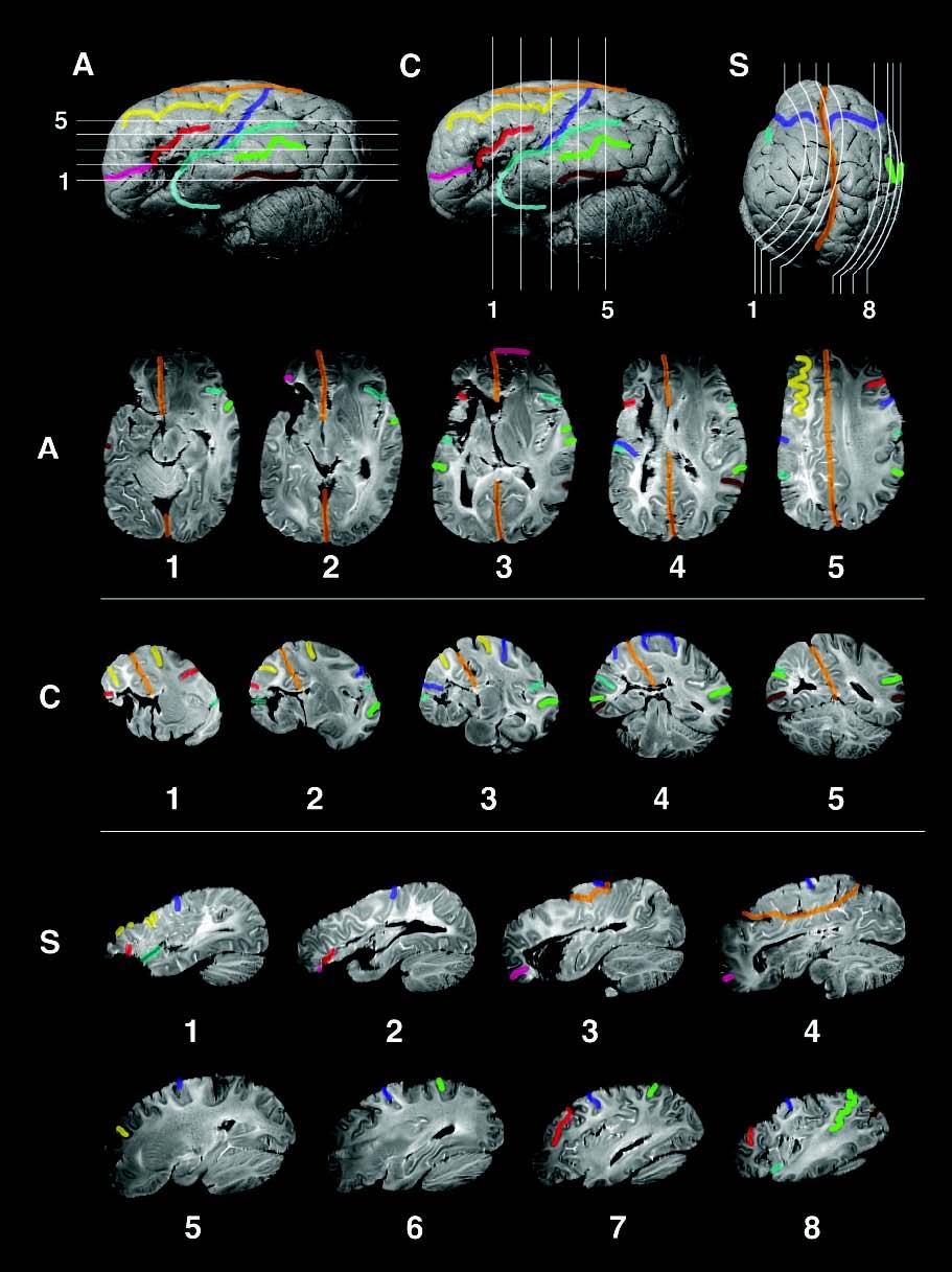 High-Resolution MRI of Leborgne/Tan reveals extensive medial damage including arcuate/ superior longitudinal fasciculus Oxford University Press. All rights reserved.