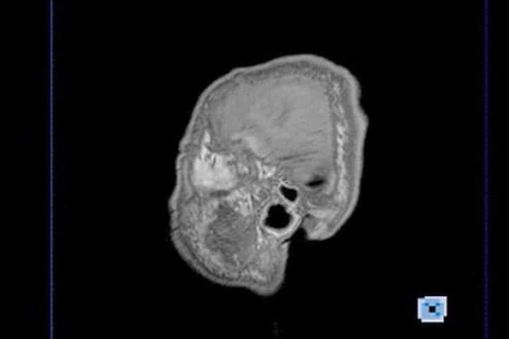 MRI Lateral Views Courtesy of