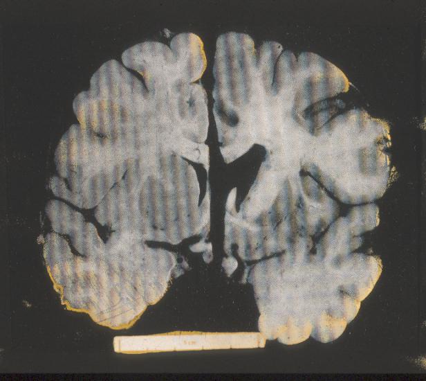 Huntington s disease post mortem source unknown. All rights reserved.