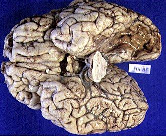 LESIONS Causes of Brain Injury stroke (CVA) : blood flow is disrupted hypoxia : lack of oxygen tumors : abnormal cell growth degenerative disorders : Alzheimer's, Huntington s, Parkinson s,