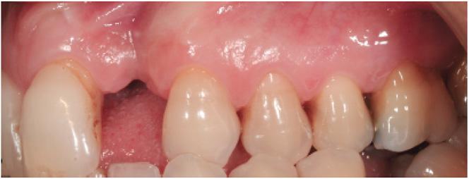 FIGURE 1 Initial clinical view of the deficiency. A slight vertical defect is observed, indicating an esthetic challenge from the restorative perspective.