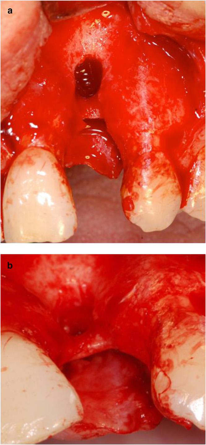 Autogenous block graft is considered the gold standard in ridge augmentation procedures because of its osteogenic, osteoinductive, and osteoconductive properties.