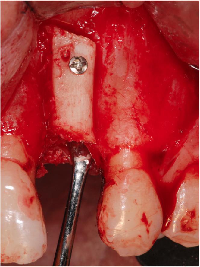 FIGURE 4 Adaptation of one of the monocortical grafts to the recipient site anchored to the residual ridge by two 1.5-mm titanium fixation screws.