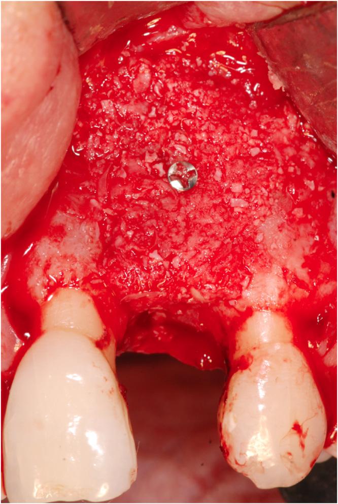 The purpose of this case report is to describe the use of autogenous block grafts, GBR, and plateletrich plasma (PRP) in vertical and horizontal bone augmentation of an atrophic maxillary anterior