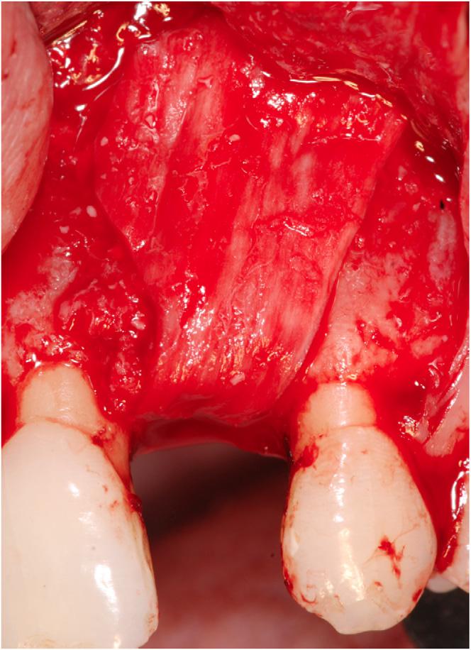 FIGURE 6 Absorbable membrane placed over the particles to promote bone regeneration. release was performed to achieve tension-free primary wound closure.
