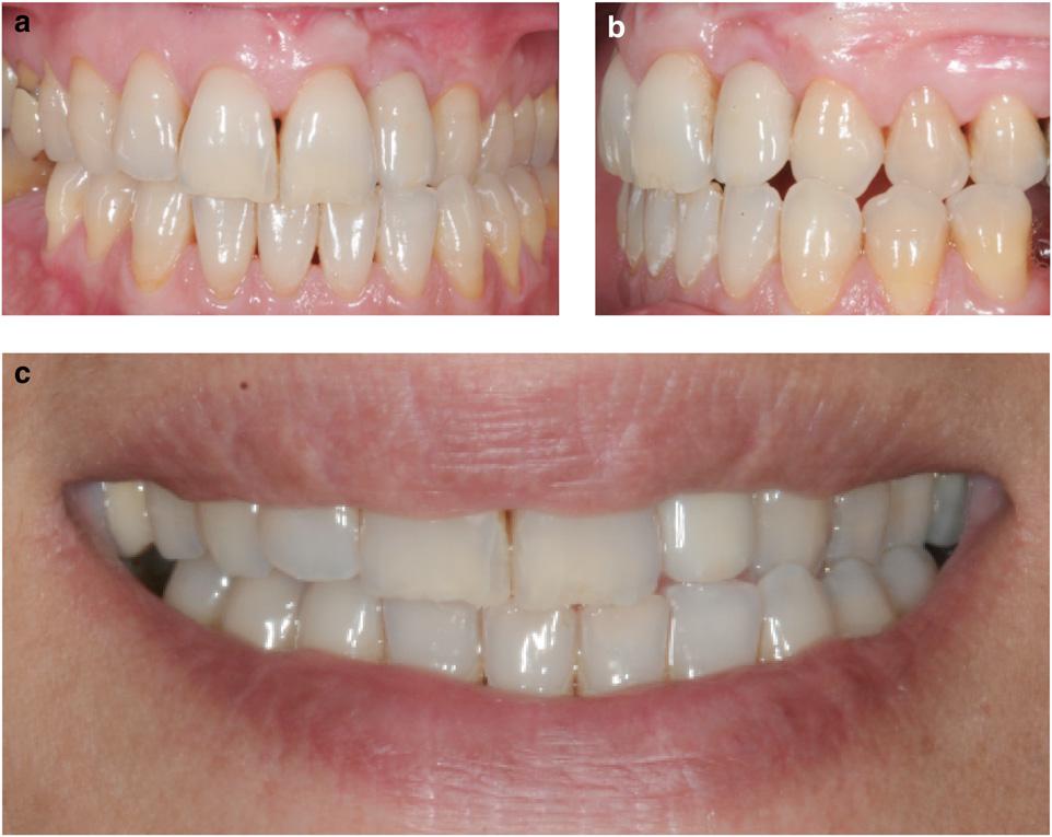 FIGURE 12 Final clinical extraoral views of the restoration. A harmonious gingival margin preserving a convex contour can be observed. 12a Frontal view. 12b Lateral view. 12c Smile after restoration.