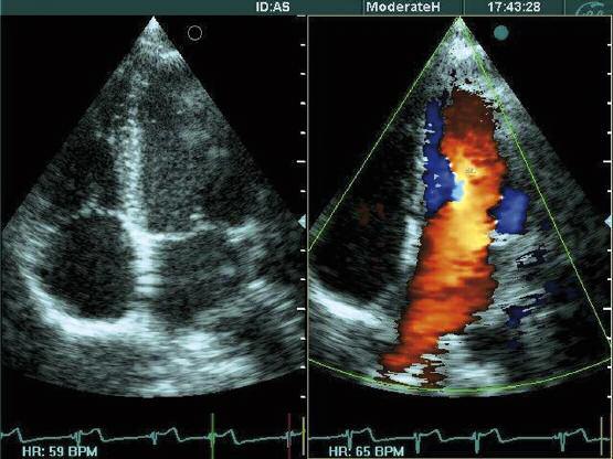 Amiodarone-induced thyrotoxicosis with paroxysmal supraventricular (ectopic atrial) tachycardia: case report and review of the literature Table I.