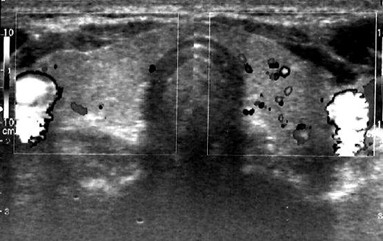 to prevent iatrogenic hypothyroidism, a normal thyroid image was observed.