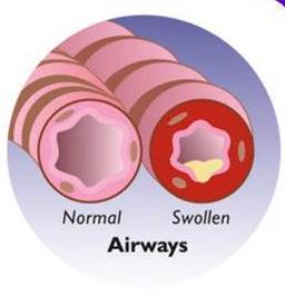 Early Asthma Tightening of the muscles narrows the air tube and impedes flow
