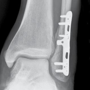 screws Short oblique fibula fractures Sizes: Lengths: