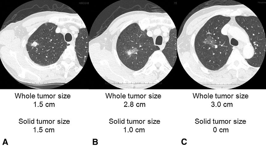 FIGURE 1. Examples of whole and solid tumor sizes on high-resolution computed tomography. A, Whole tumor size, 1.5 cm and solid tumor size, 1.5 cm. B, Whole tumor size, 2.8 cm and solid tumor size, 1.