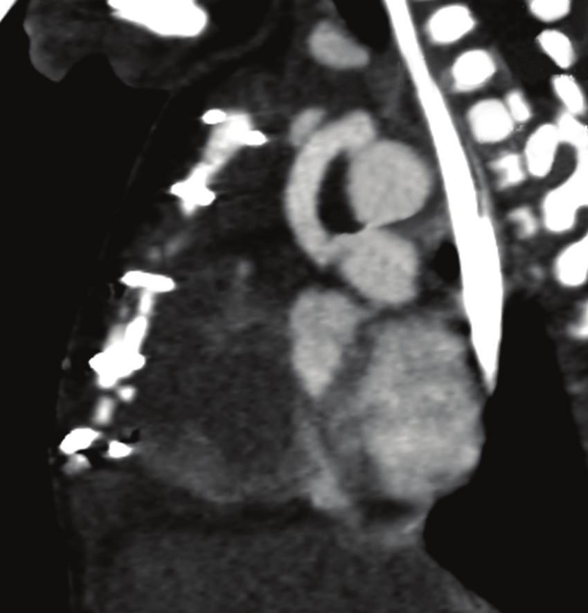 2 Case Reports in Cardiology Figure 1: CT angiography (sagittal view) demonstrating a narrowing of the modified BT shunt at the point of anastamosis with the pulmonary artery.
