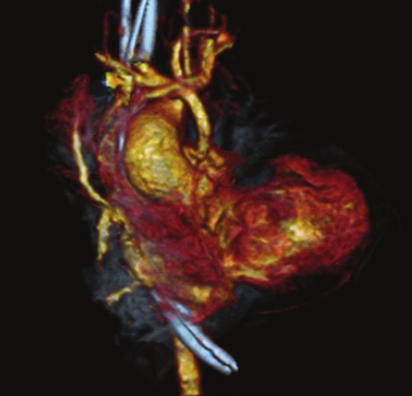 5 millimeter modified Blalock- Taussig shunt with transection and oversewing of the main pulmonary artery. Her initial postoperative course was uneventful.