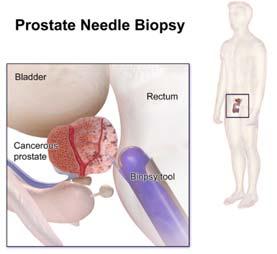 Biomarkers may predict aggressive prostate