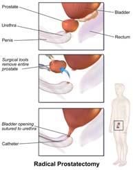 Treatment options for localized prostate cancer Active Surveillance Surgery Radiation