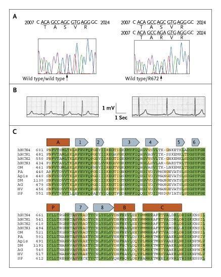 Familial sinus bradycardia Autosmal dominant Point mutation in the HCN4 cardiac ion channel pore Genetic testing could play an important role in the differentiation between