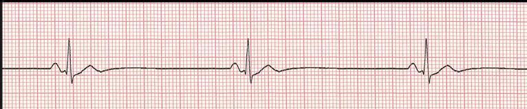 Asymptomatic bradycardia A condition in which a person has bradycardia, or a slow heart rhythm, without any of the classic symptoms of bradycardia (dizziness, irregular