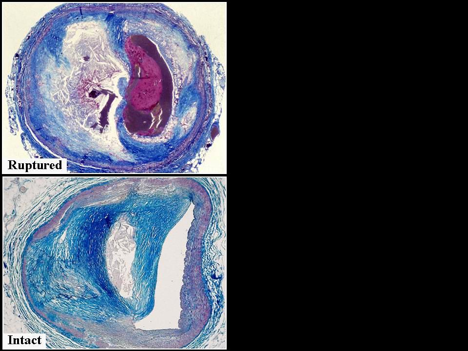 Coronary Atherosclerosis targets for imaging Ruptured Intact Ca core thrombus cap lumen Plaque size Necrotic core ~34% of plaque area * ~3.