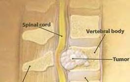Spinal Cord Compression spinalcordcompression.jpg At this point Mr.