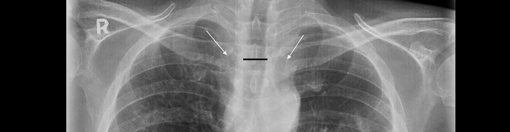Measurement of tracheal diameter from chest X-ray:
