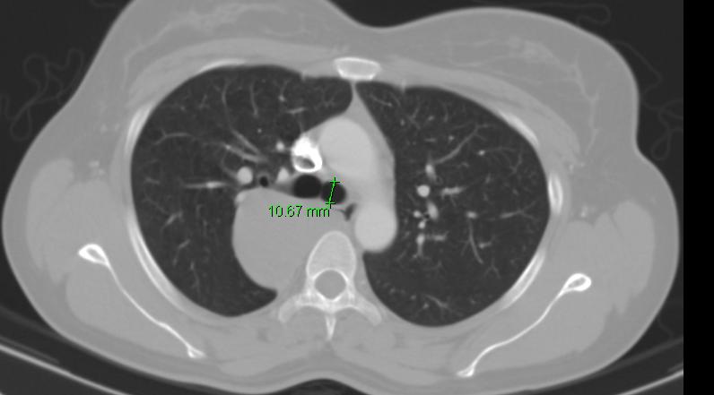 Measurement of right bronchial diameter from computed tomography of the thorax: Diameter of right main bronchus, just beyond carina (green line)
