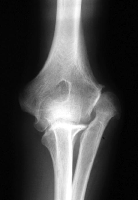 BILATERAL CHRONIC DISLOCATION OF THE RADIAL HEAD: Usually symmetrical but may be asymmetrical.
